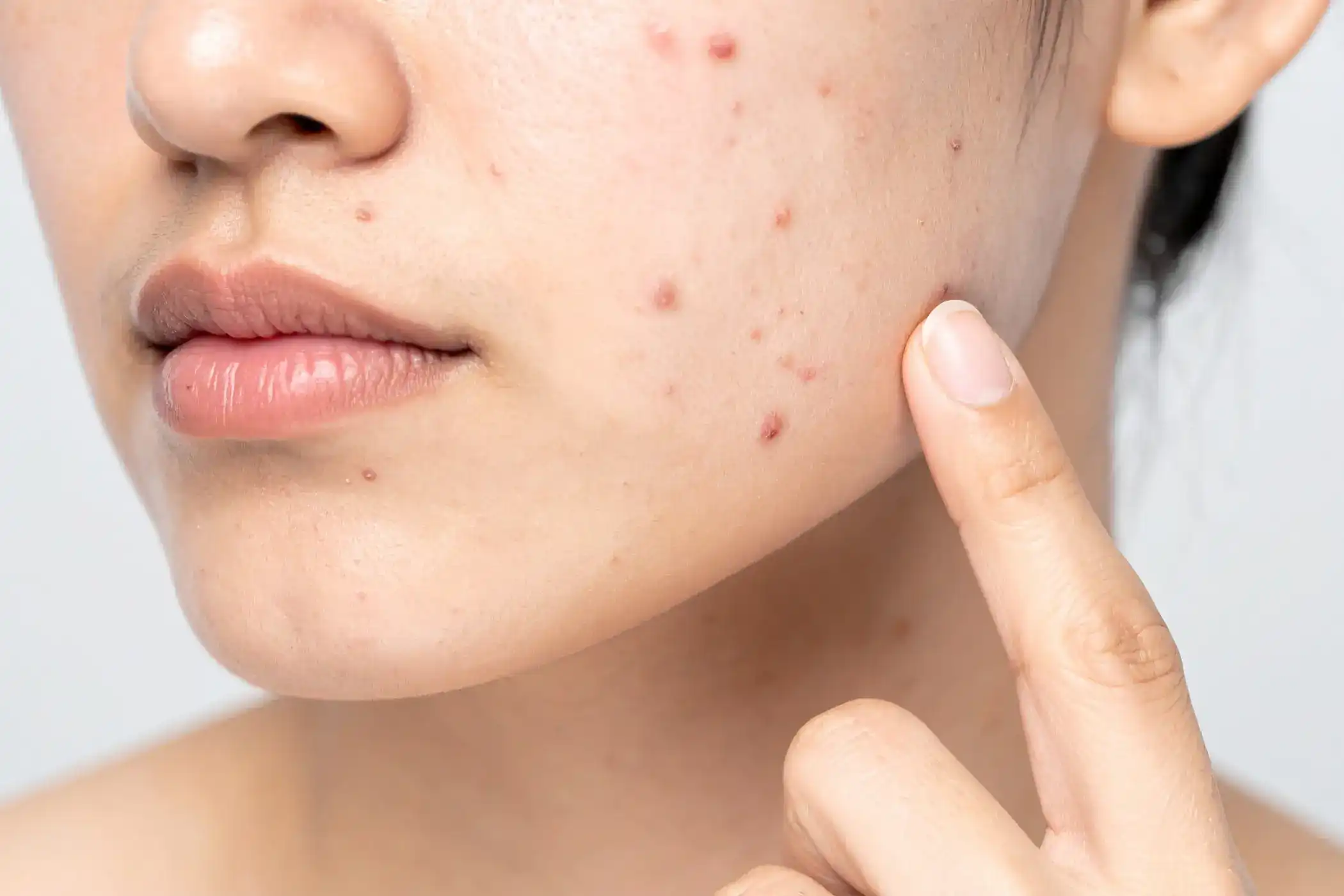 Why Is Your Skin Oily and Acne-Prone?